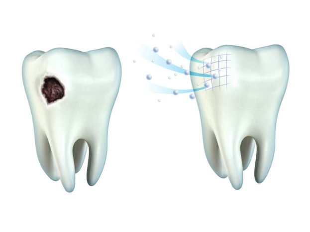 oral-fistula-saat-gigi-berlubang-menyebabkan-kematian-3